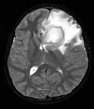 absceso cerebral 