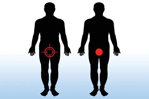 balanopostitis en los hombres