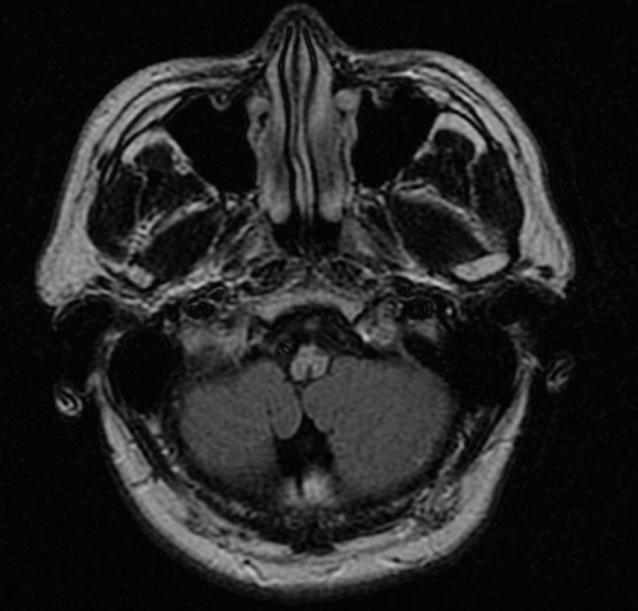 La enfermedad de Alexander. Formularios Diagnostico Pronóstico