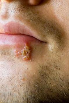 razón del herpes