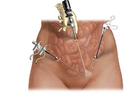 ¿Cuál es el propósito de la laparoscopía para los ovarios?