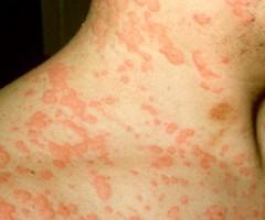 tratamiento de la urticaria en el hogar