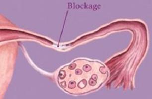 Tubo de falopio en mujeres: ¿qué es? Inflamación de las trompas de Falopio. Obstrucción de las trompas de Falopio