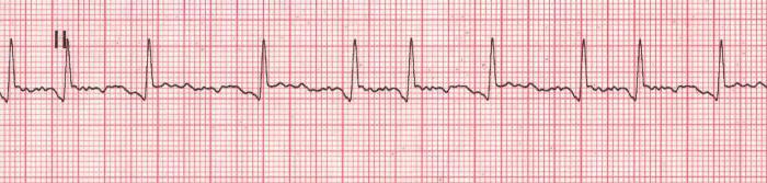 Fibrilación auricular en el ECG. Aleteo auricular