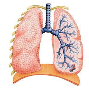 Enfermedad pulmonar obstructiva crónica: una amenaza para la vida de los consumidores de tabaco