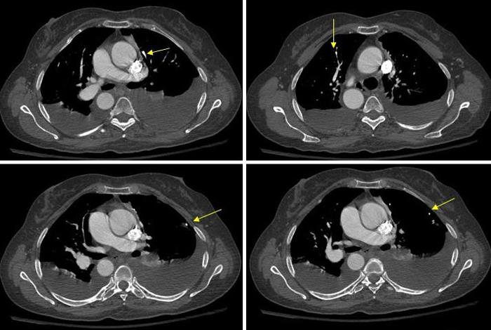 Tomografía computarizada de pulmones: diagnóstico moderno