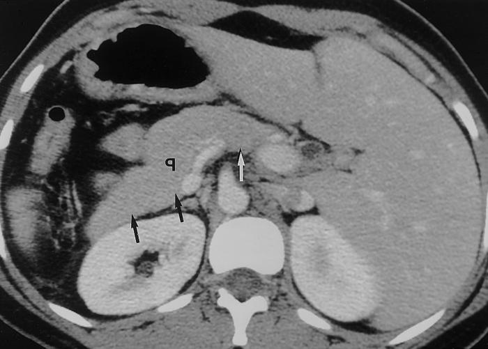 Necrosis pancreática: causas, síntomas, tratamiento