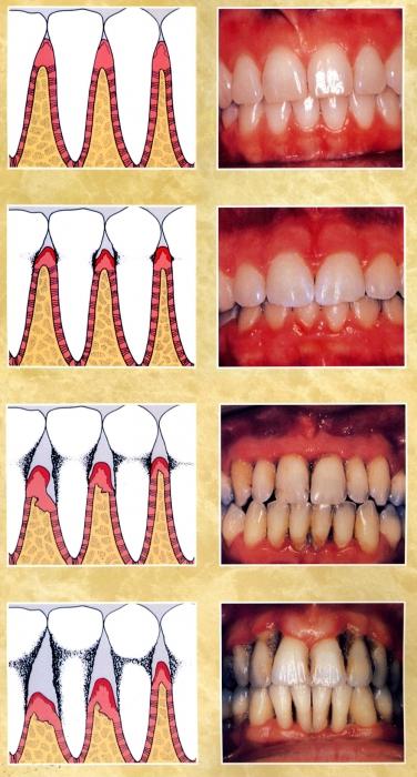 síntomas de la periodontitis