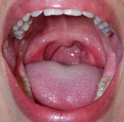 Síntomas del cáncer de laringe y etapa de la enfermedad