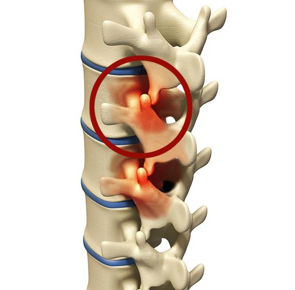 espondilartrosis de la columna lumbosacra