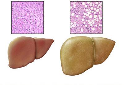 síntomas de esteatohepatosis